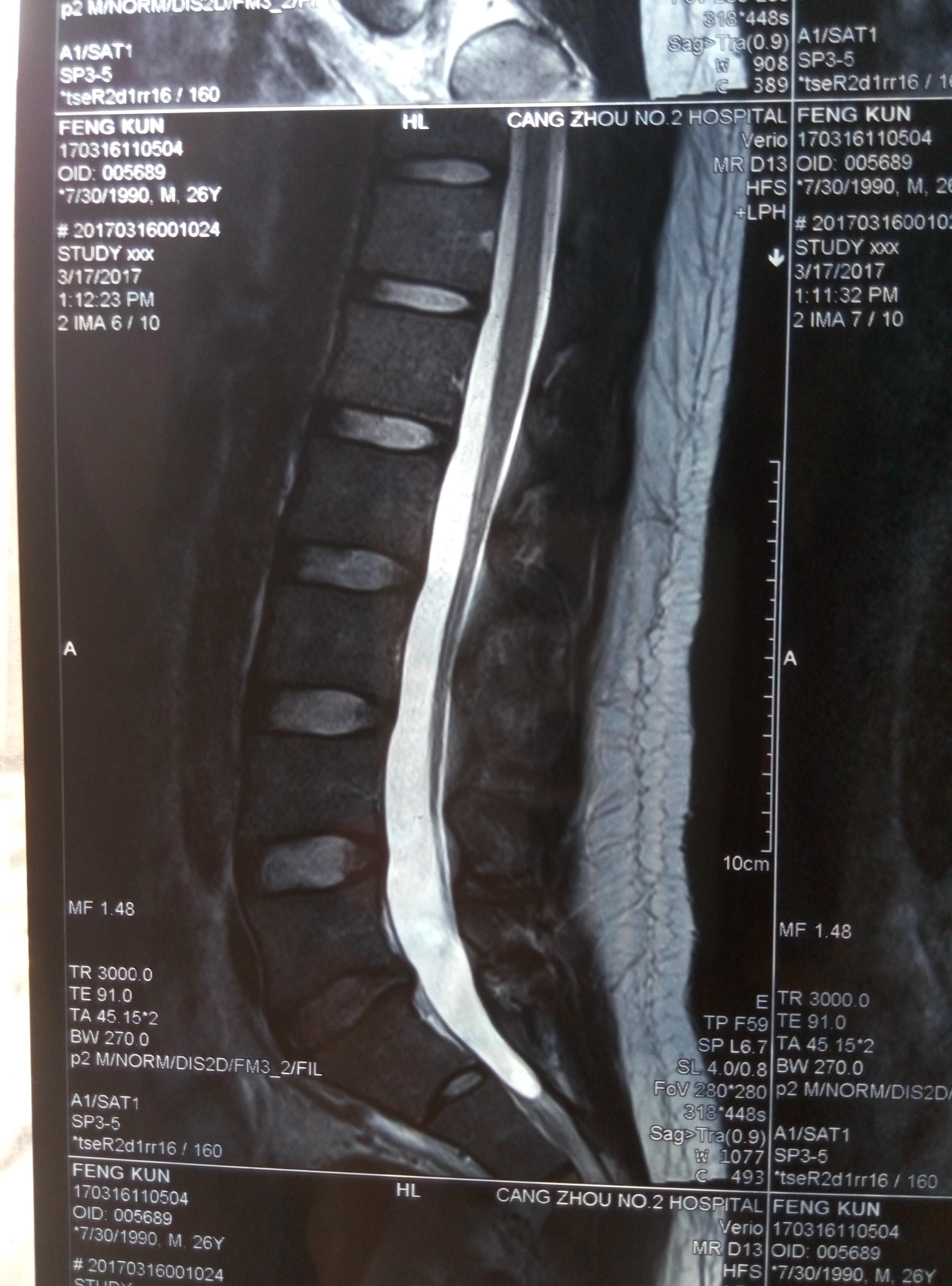 脊髓或腰突x线腰椎下背盘下盘骨的磁共振成像或MRI扫描报告 库存图片 - 图片 包括有 医疗, 检查: 238804081