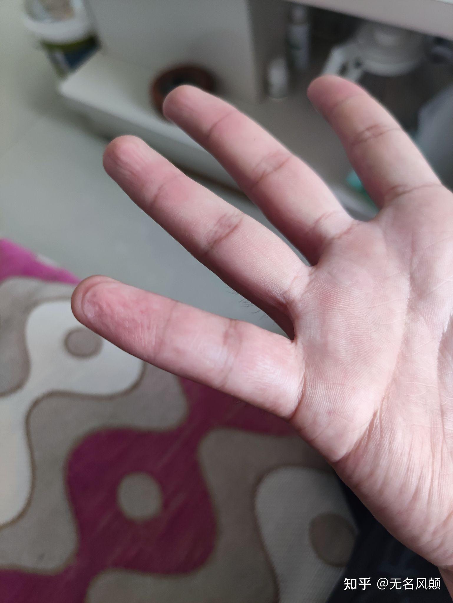 打篮球时手指戳伤不能伸直求有经验的大神告诉我这是否严重啊