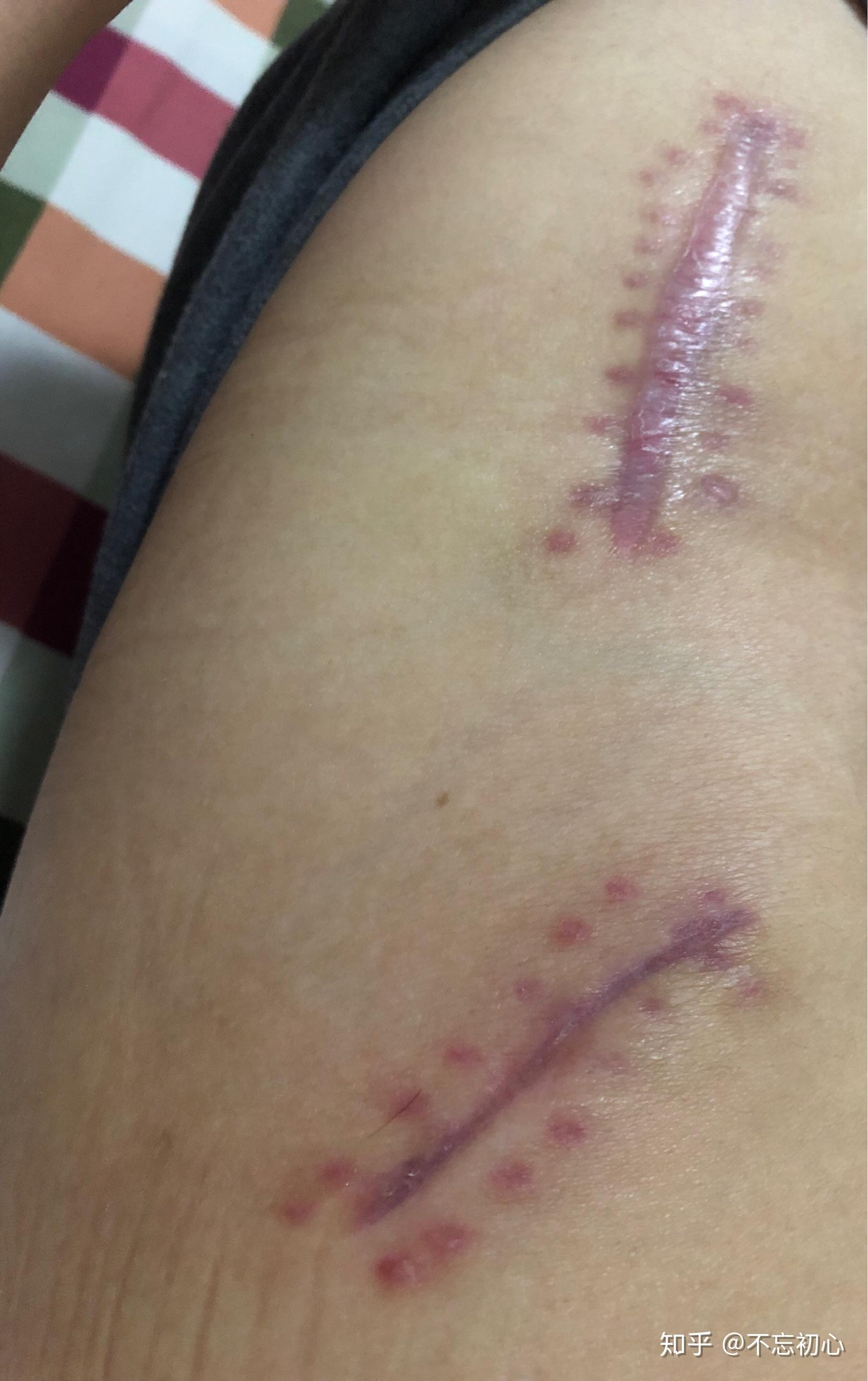 股骨头植骨钻孔手术后50天了