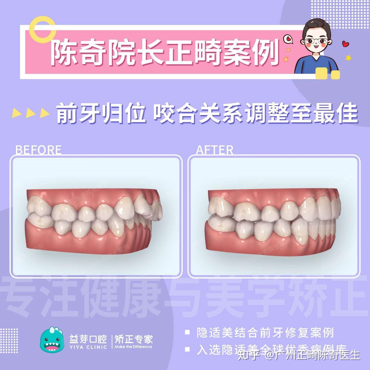 近七成中国孩子都有的“错颌畸形”，再不干预就晚了！ - 知乎