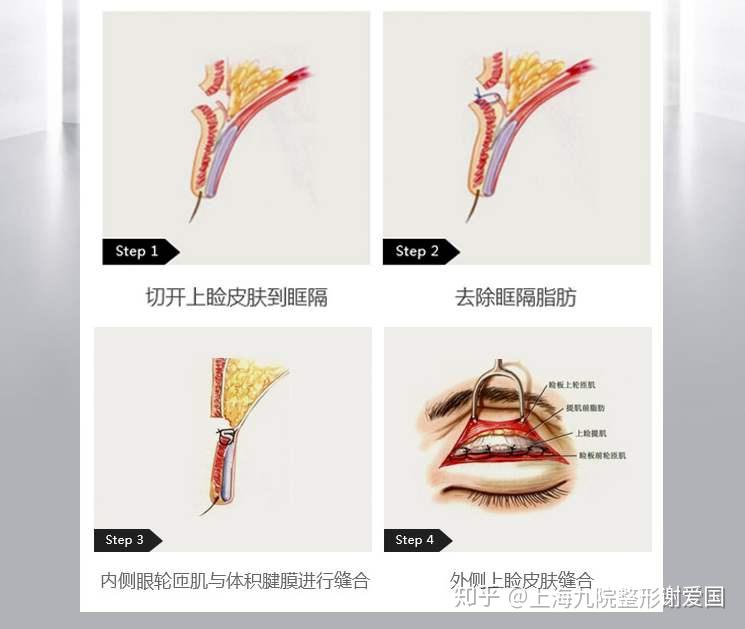 双眼皮术式什么是park法