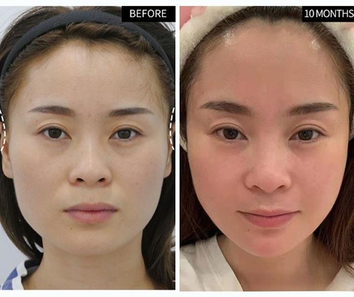 36岁“短方脸”女士奔赴北京,做全脸整形后,重新开启自信人生 - 知乎