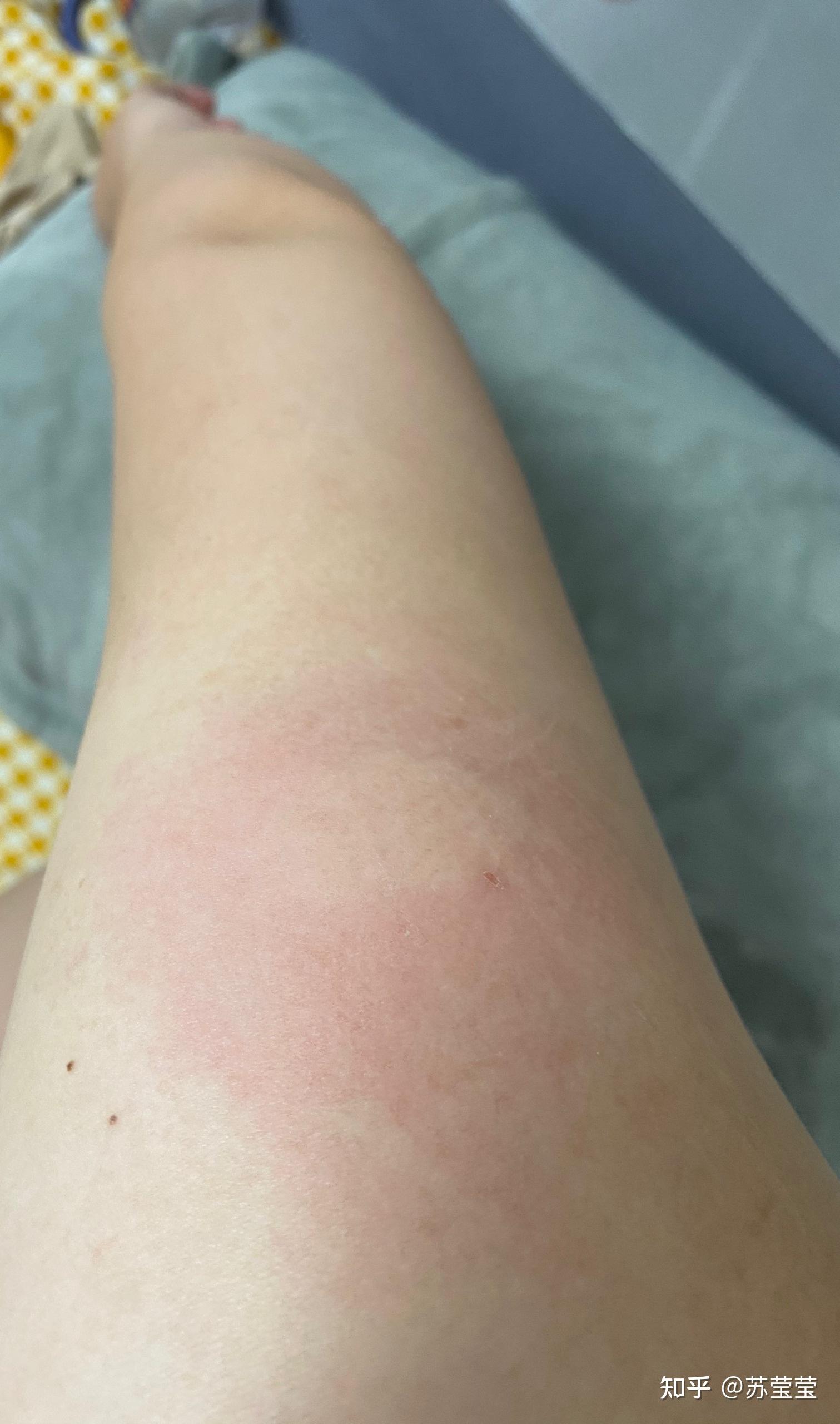 15日接种第二针cho疫苗第二天接种部位红肿痒怎么办