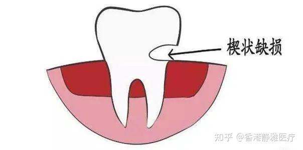 什么原因会导致牙齿断裂