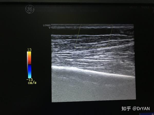 上臂头静脉 球囊扩张成形术 分别在人工血管动,静脉侧留置血管鞘,经鞘