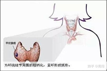 甲状腺钙化了——到底严不严重? - 知乎