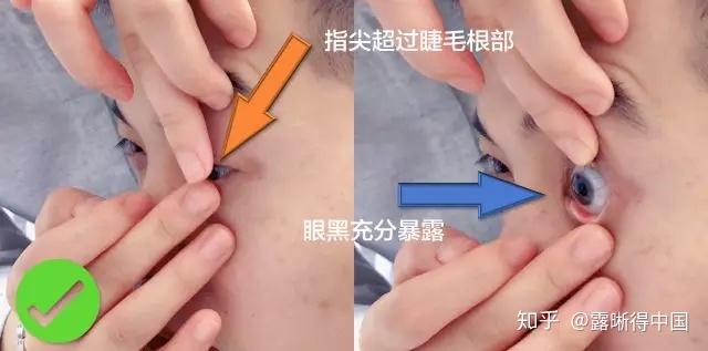 过睫毛:扒开眼睑时指尖需稍稍超过睫毛双眼睁:戴镜时需要双眼睁开而不