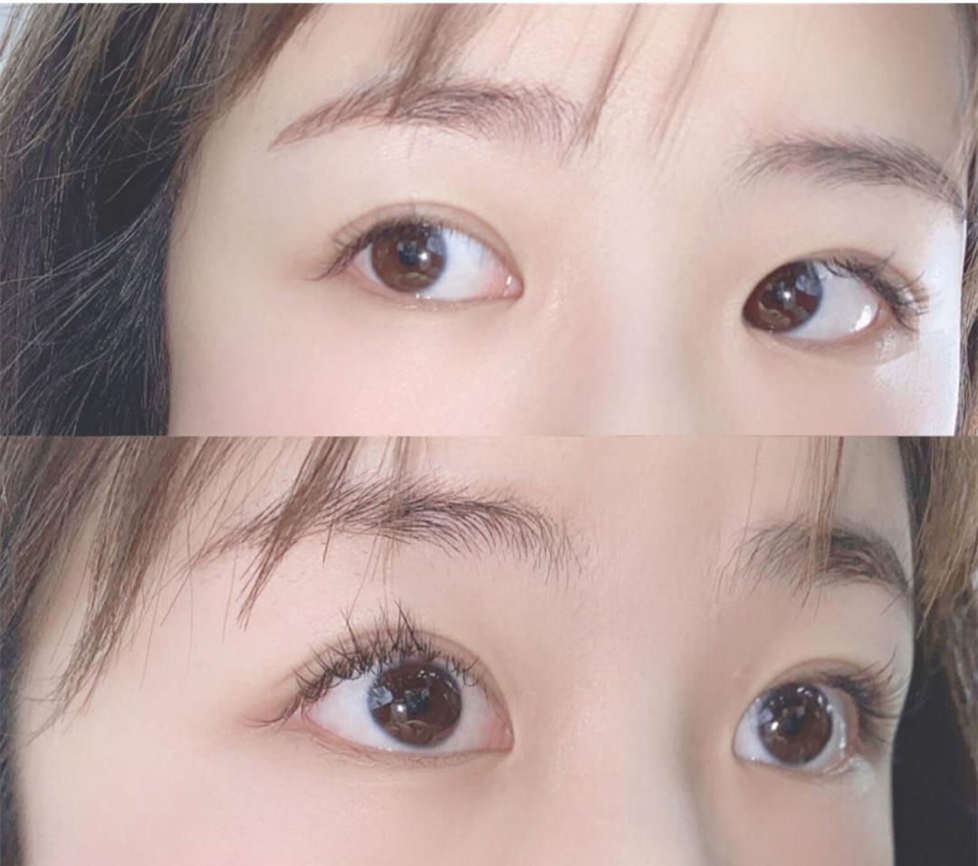 全切双眼皮做多宽比较自然什么时候开始疤痕增生疤痕增生怎么办