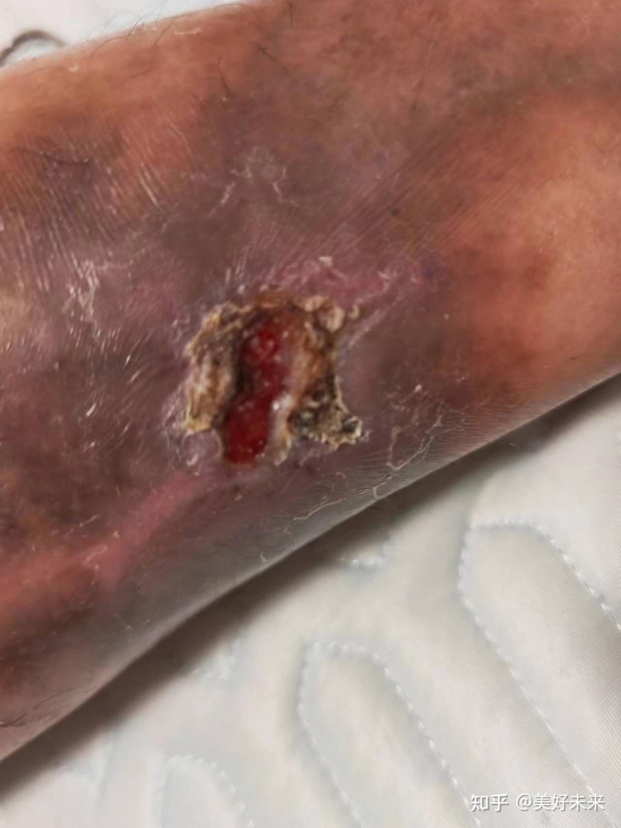 血栓性静脉炎病发时常伴随着哪些症状