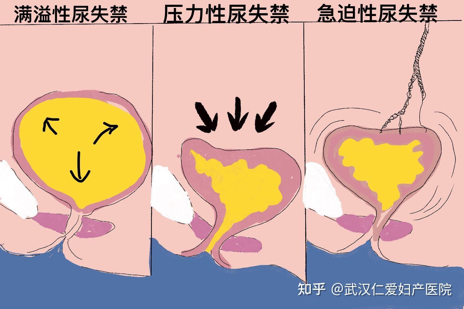 尿失禁分类图片