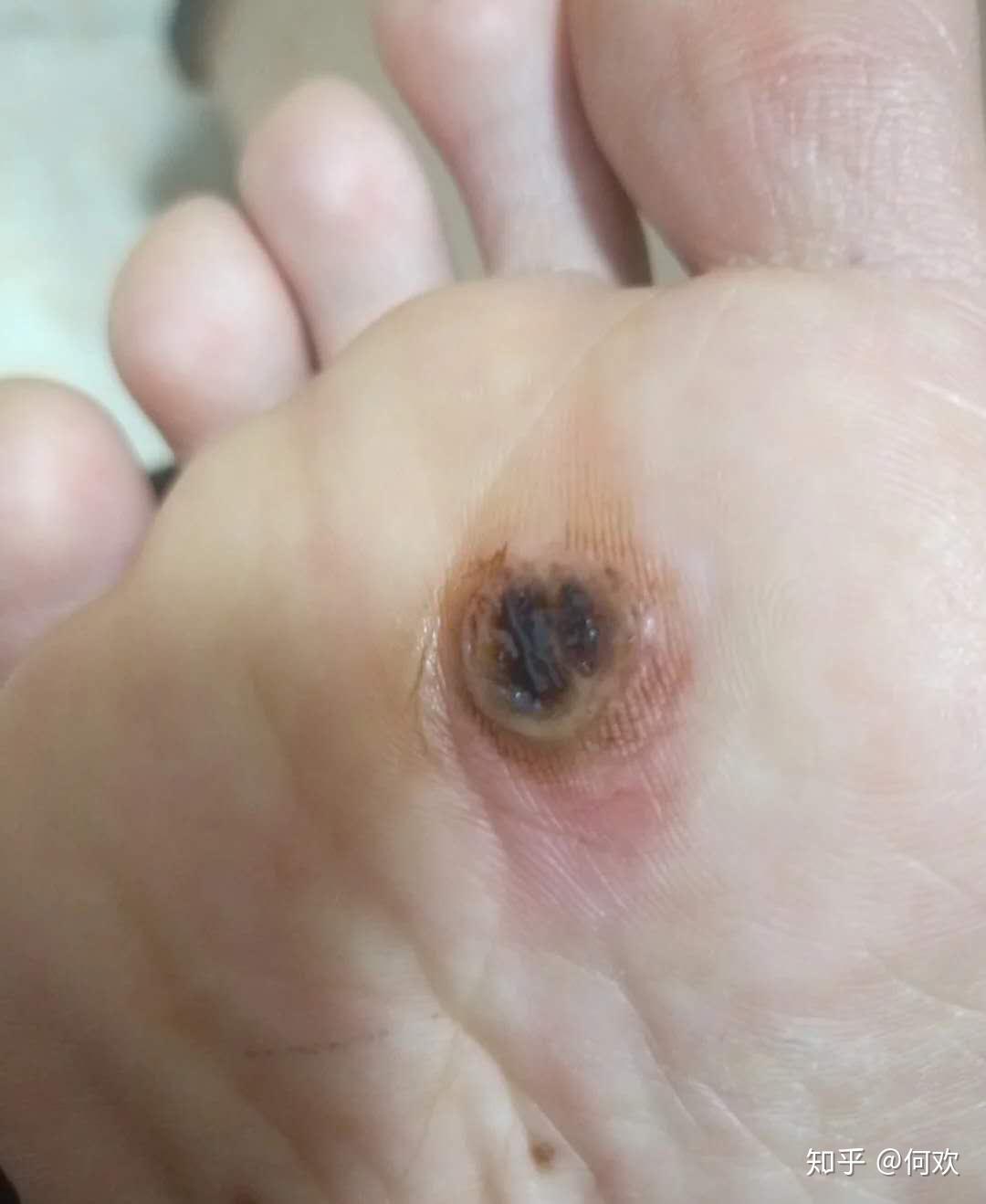 脚上长了鸡眼用什么方法可以治好呢