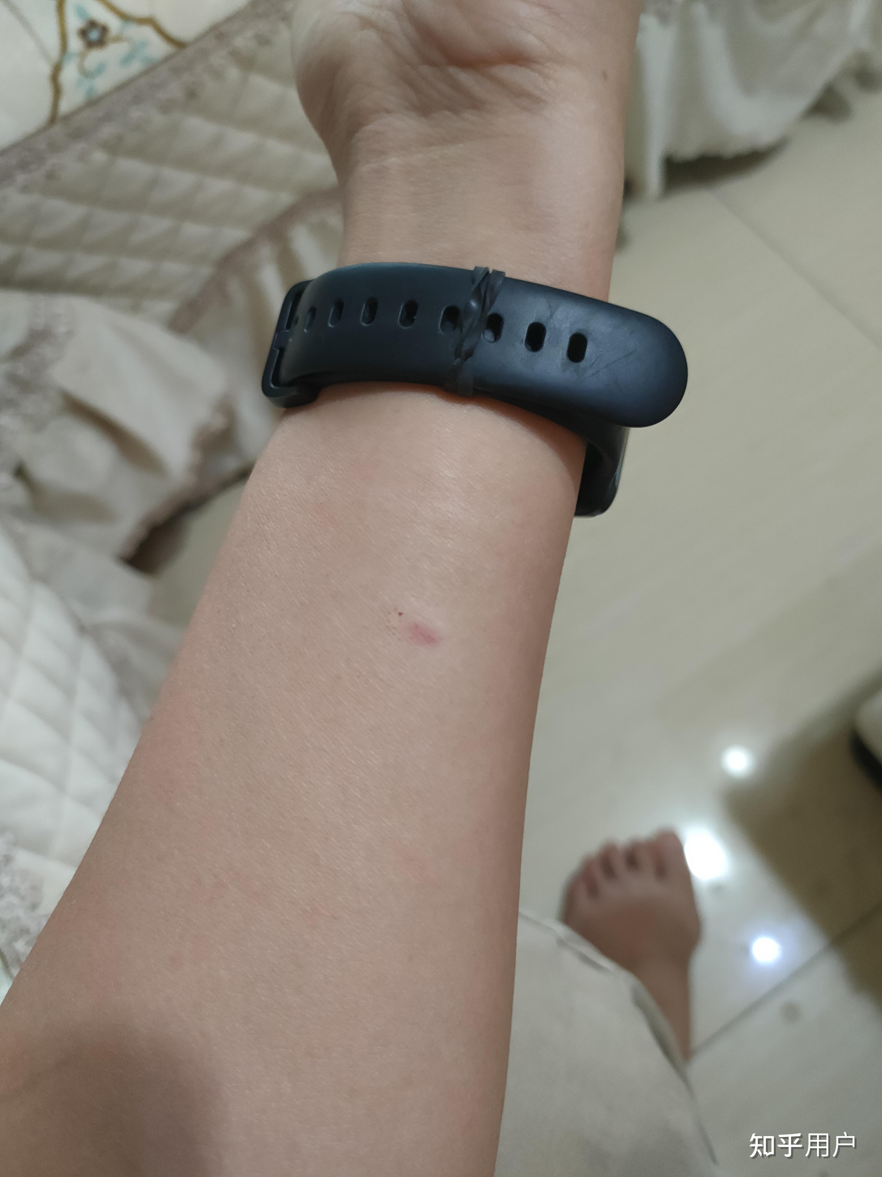 ppd皮试后这个样子怎么办?