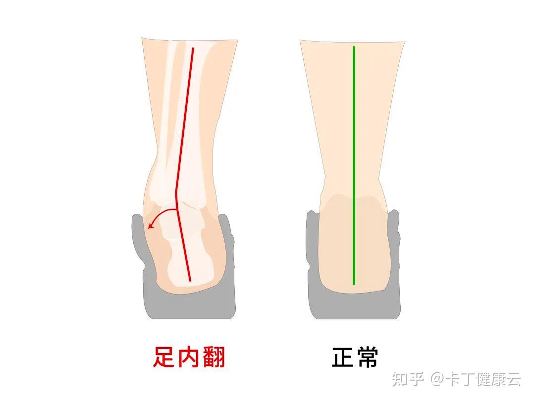脚背过高是一种什么体验?买不到合适的鞋子,还会足部不适! - 知乎
