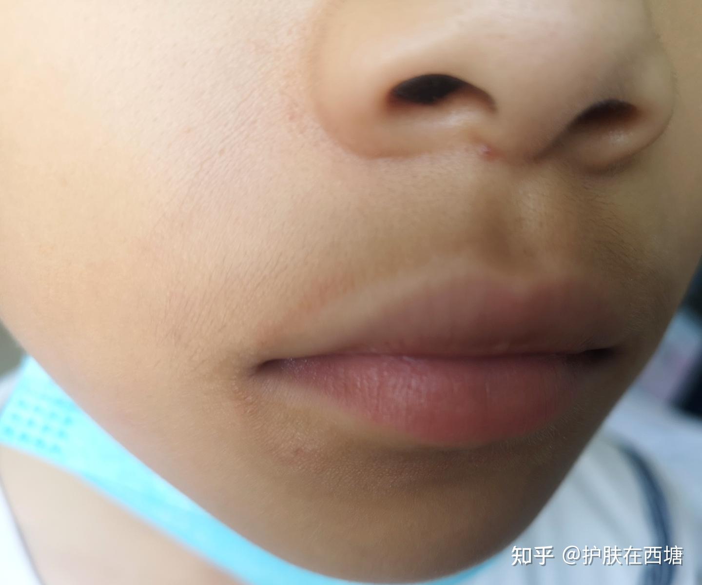 口周红肿,是吃错什么了吗? - 知乎