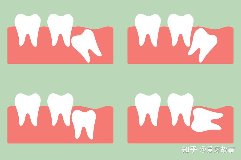 收藏不同年齡階段的護牙攻略