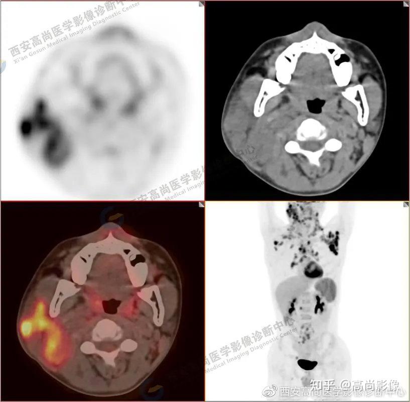 西安高尚医学影像病例 经典型霍奇金淋巴瘤pet/ct分期1例