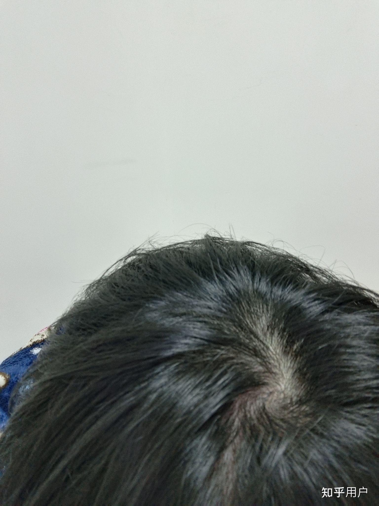 头顶旋处头发特别少咋办嘛