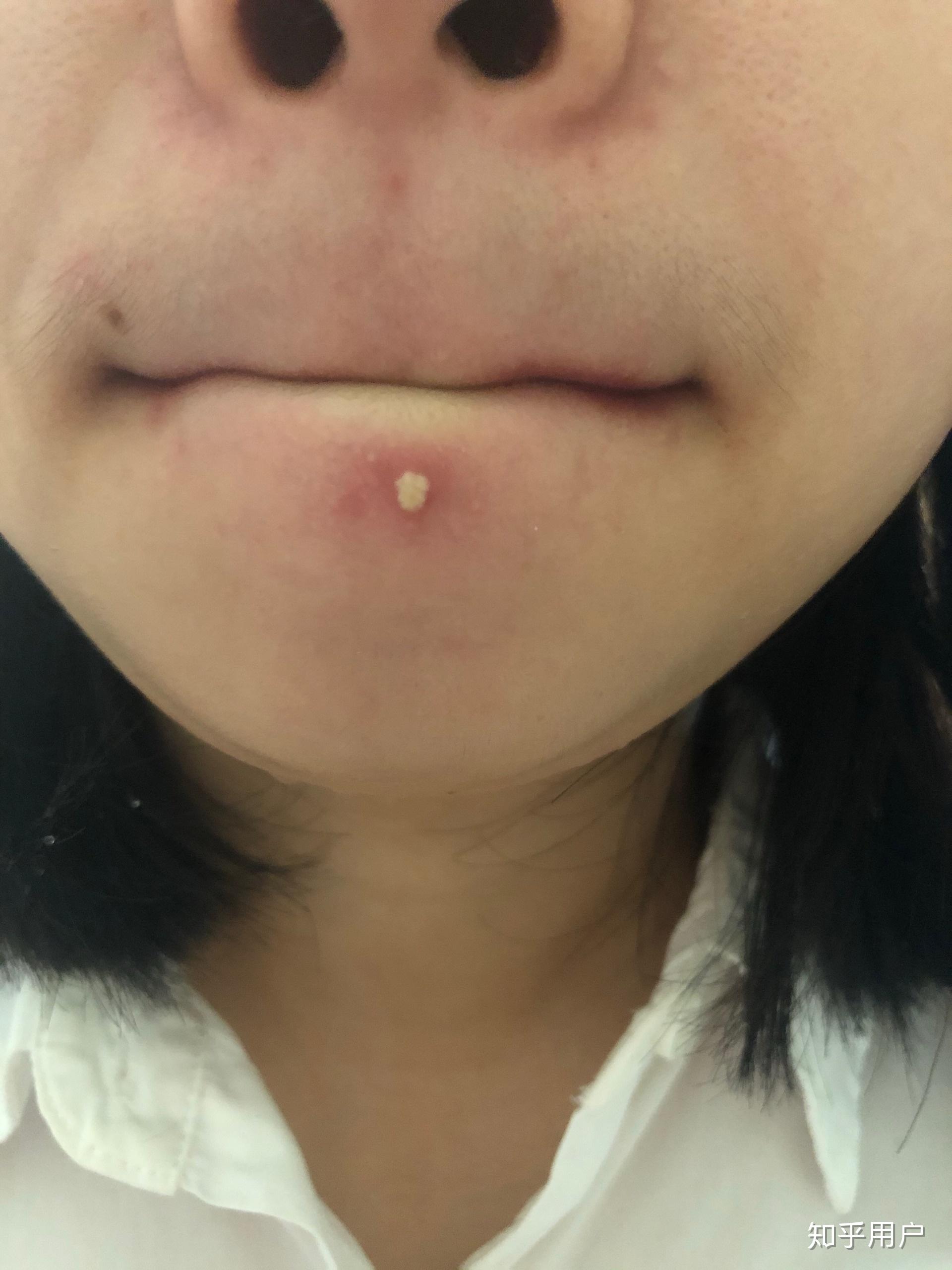 一开始下巴长了个痘我挤出了白色的东西然后没管它后来变成了一个大硬