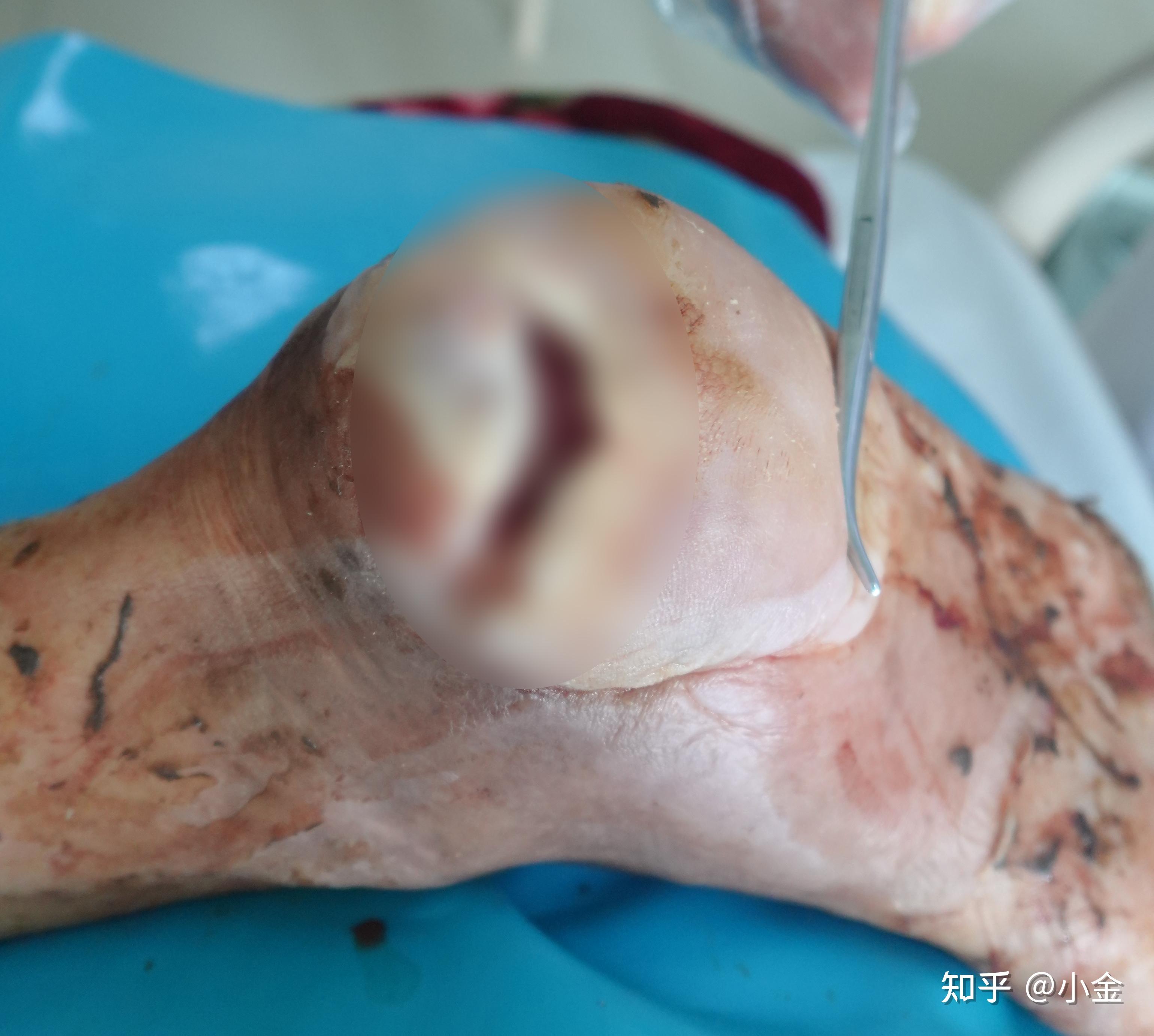 司机脚部糖尿病足溃烂用4个月还给他一只开车的脚