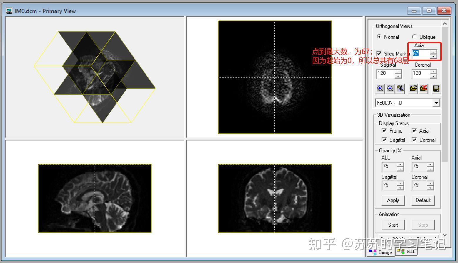Diffusion spectrum imaging (DSI) 扩散光谱成像 与 Diffision tensor imaging （DTI ...