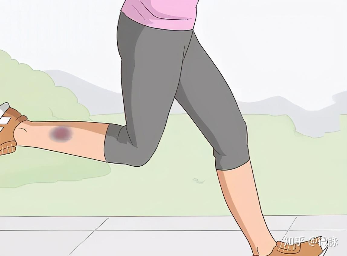 爱出汗,手脚冰凉,一碰就淤青…这 5 种体质是病吗?怎么治? - 知乎