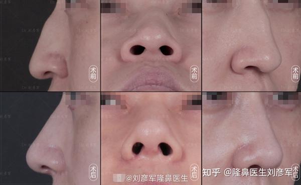 塌鼻子”不单指鼻梁,鼻尖也是重点“ - 知乎