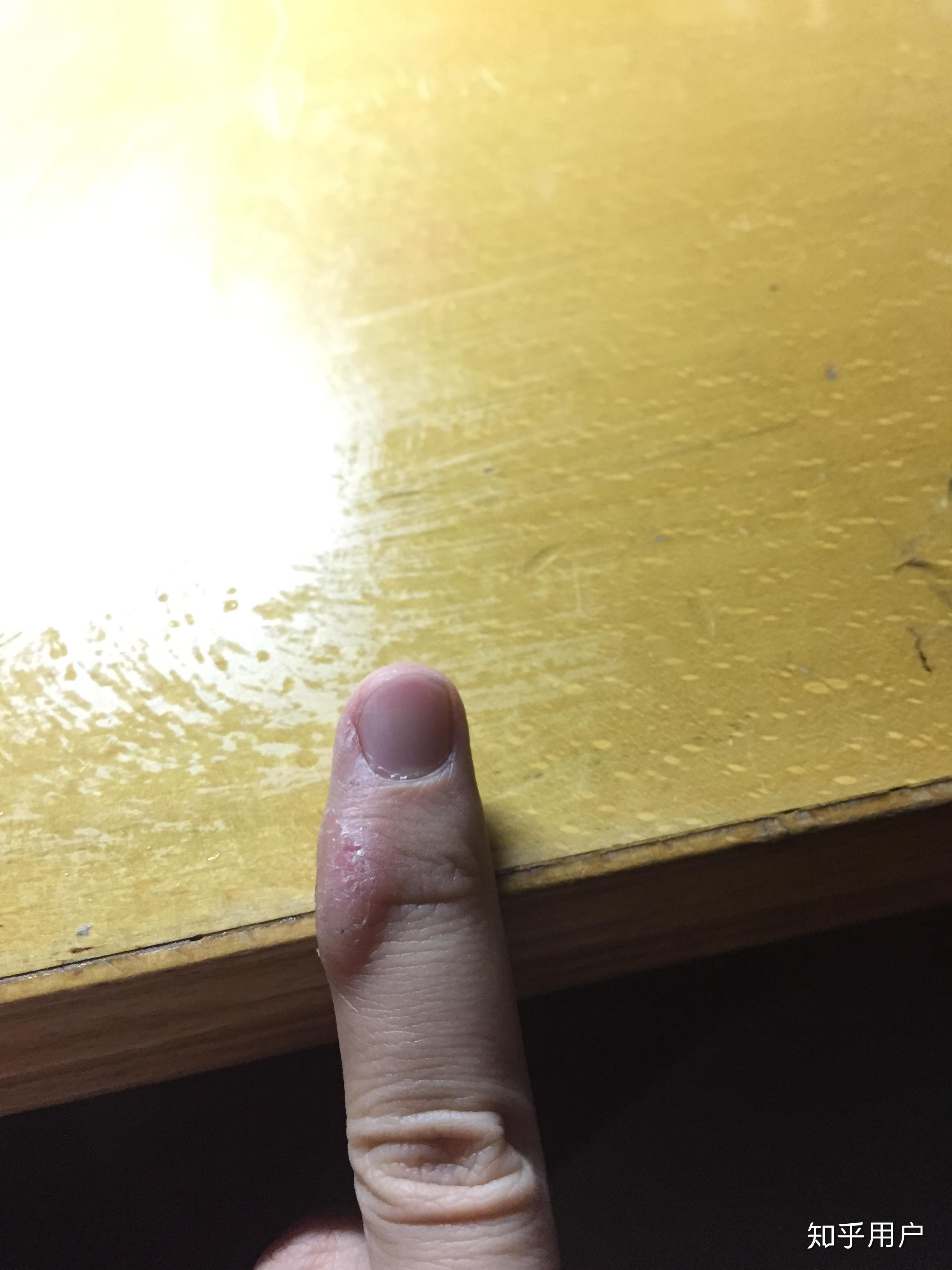 因为写字手指长得茧怎么消下去