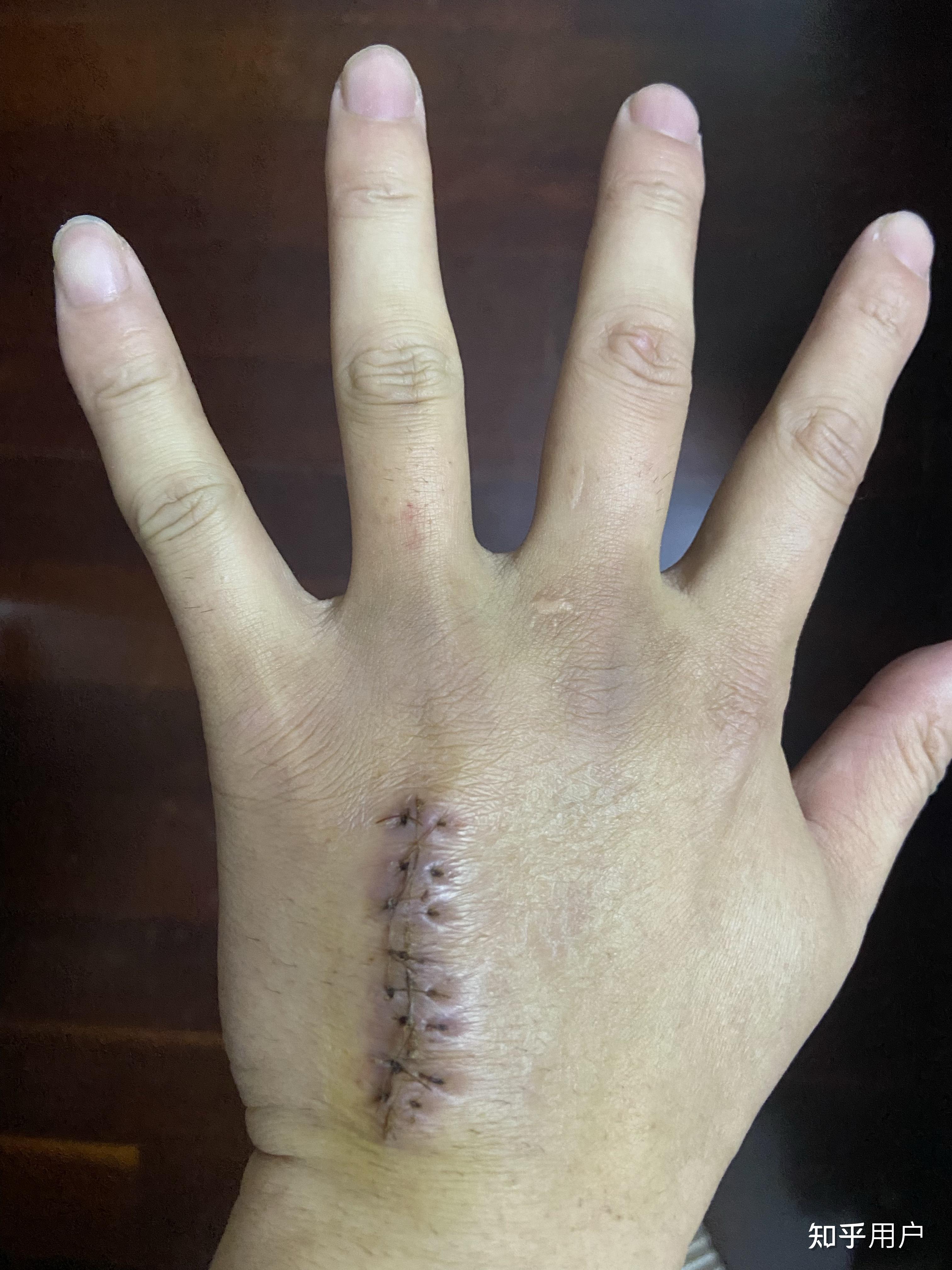 右手第四掌骨骨折保守治疗的第16天恢复的是否不太理想