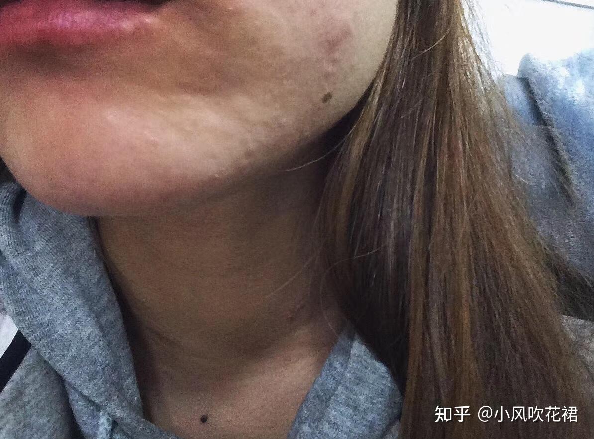 晚上虾过敏是什么感受