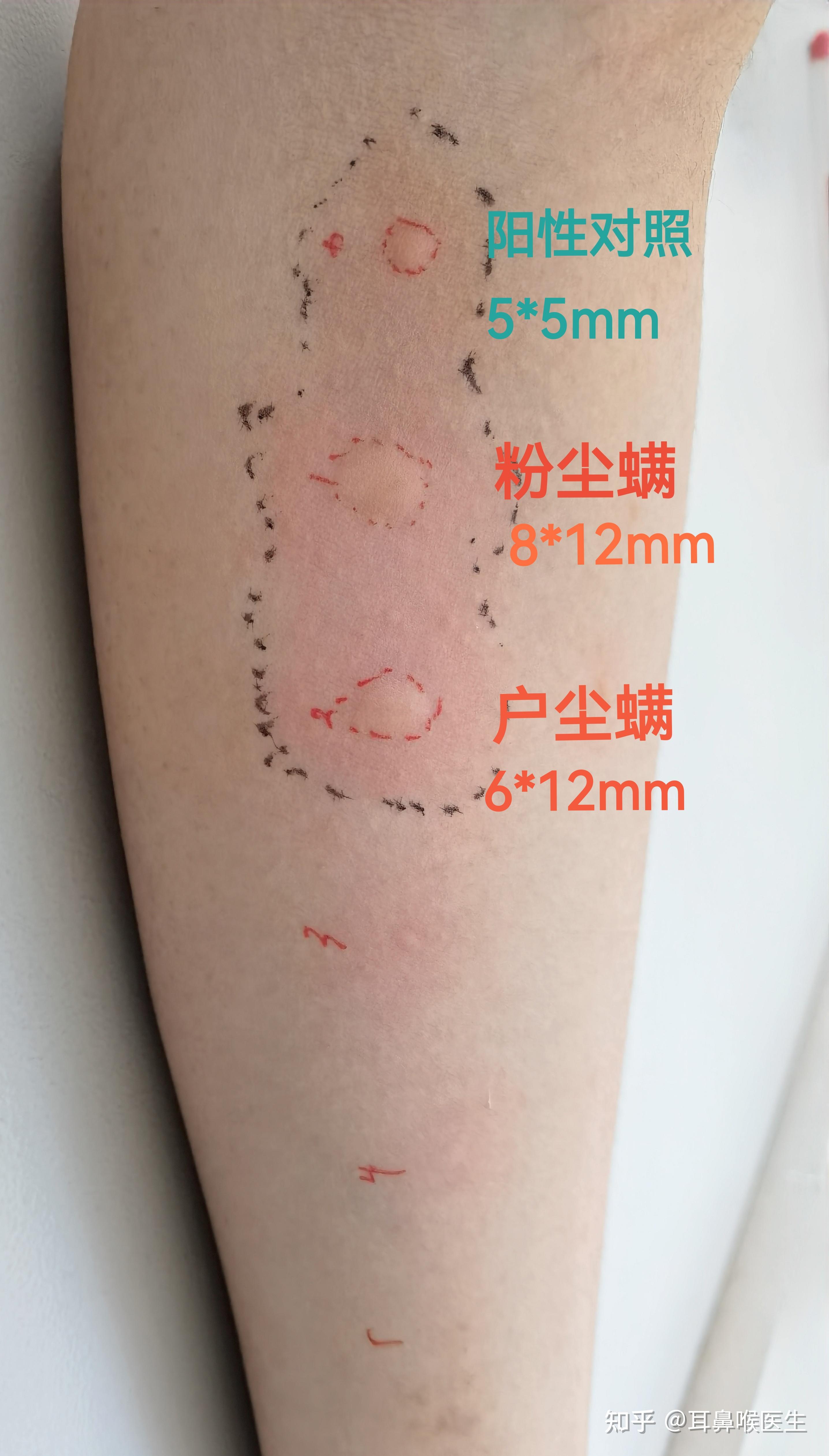 过敏性鼻炎都会经常大半夜惊醒然后打喷嚏流鼻涕鼻塞么