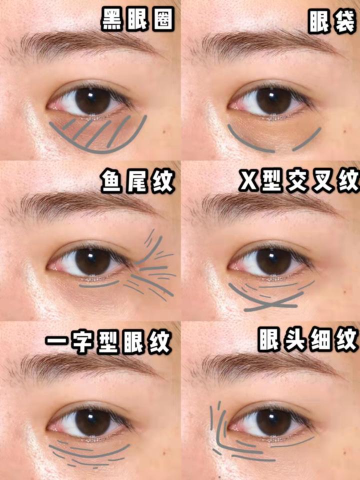 泪沟型眼袋到底该如何处理 - 知乎