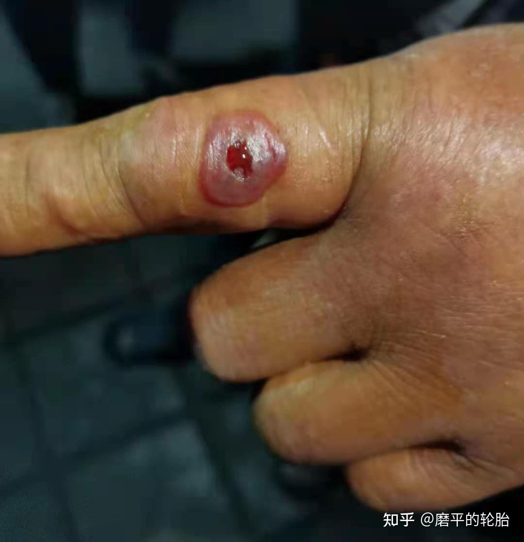 山西省文水县发生 9 例疑似皮肤炭疽疫情,病例已隔离治疗.