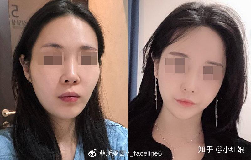 他的脸型菱角分明,但是下庭过长,有轻微的鞋拔子脸,手术过后不但让