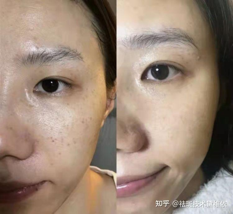 黛维依祛斑成功跟大家来分享一下我的治疗过程大家不要踩雷