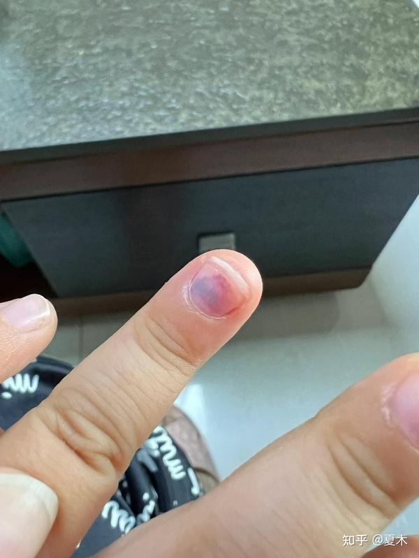 手指被门夹,孩子太可怜!建议用防夹手门档 - 知乎