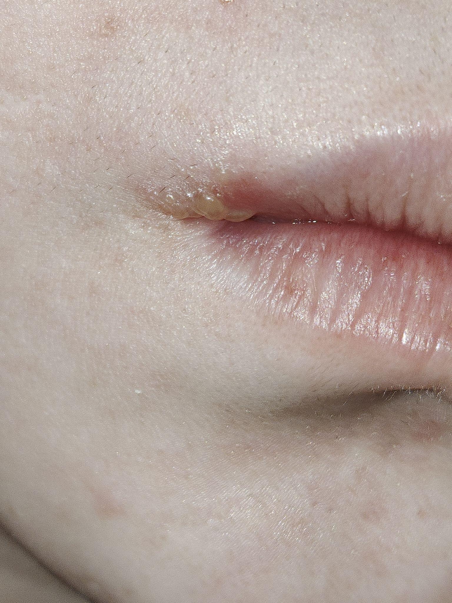 嘴角起泡如何处理可以最短时间痊愈? - 知乎