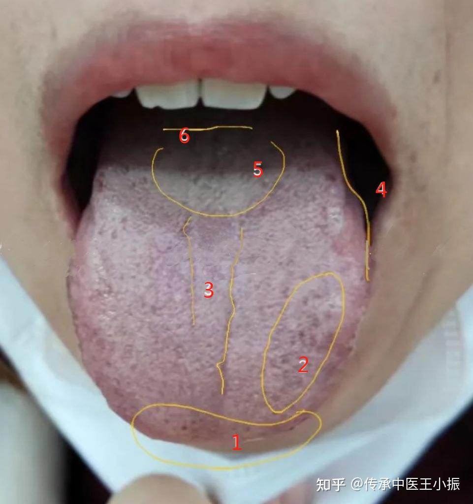 舌诊分析——舌质暗紫, 寒凝血瘀 - 知乎