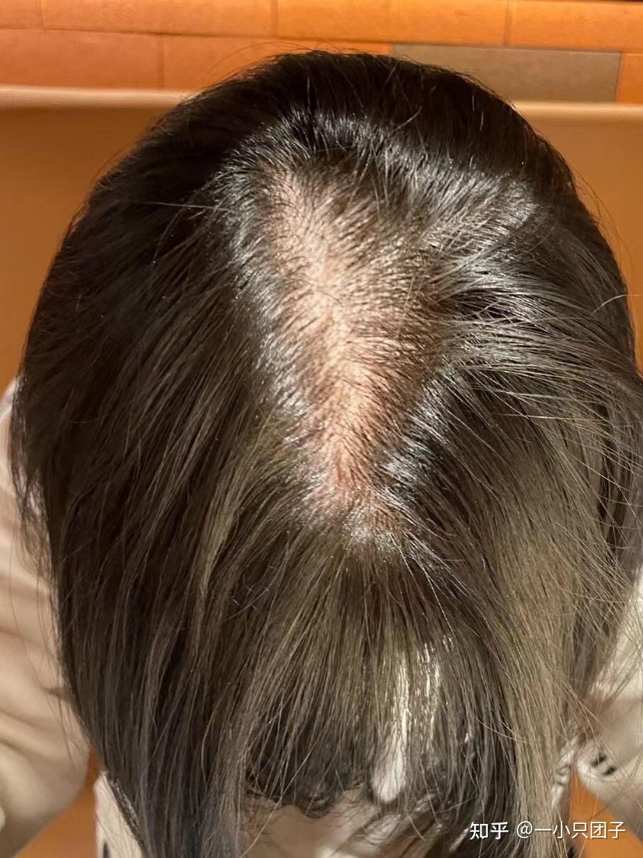 女生发量少头顶快秃了有没有什么好的生发方法跪求