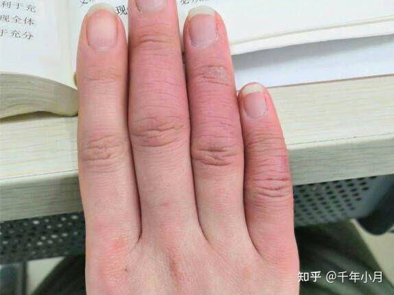 冬天冻手冻脚怎么办