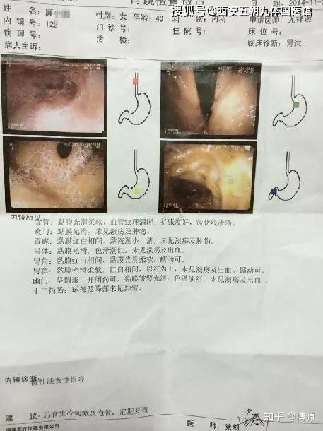 李学武脾胃病专家团队逆转萎缩性胃炎肠化异型增生成功案例分享