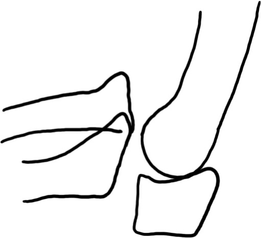 肘关节脱位 - 知乎