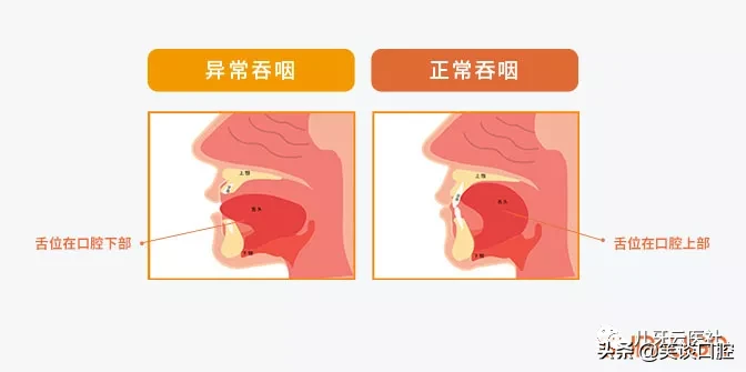 进行性吞咽困难图片