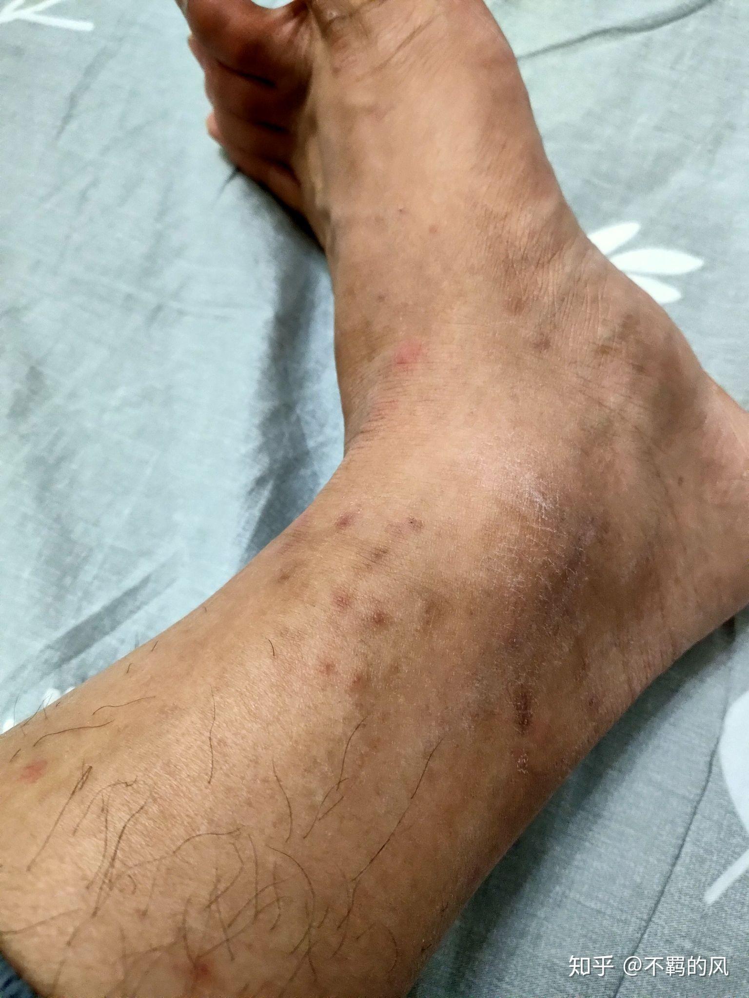 被跳蚤咬的家都不想住了,有什么办法灭了它们? - 知乎