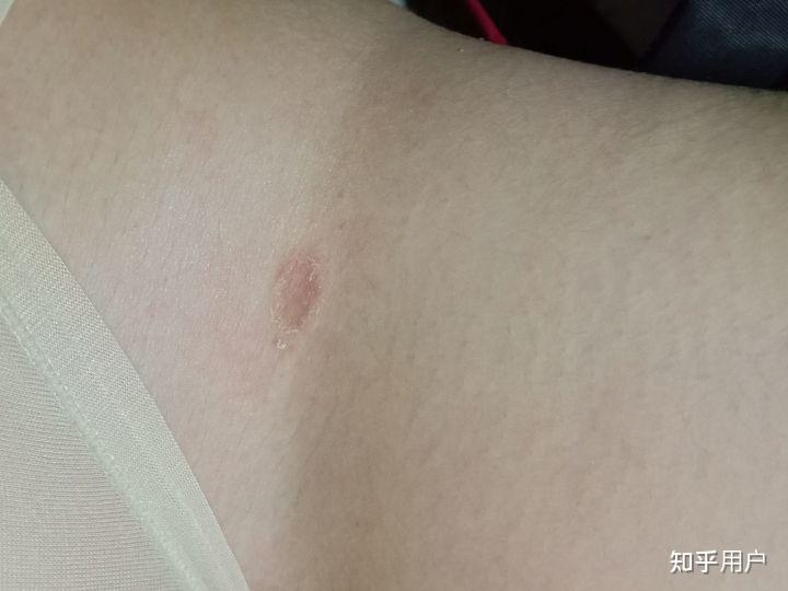【股藓】的色素沉着怎么淡化？ 知乎 