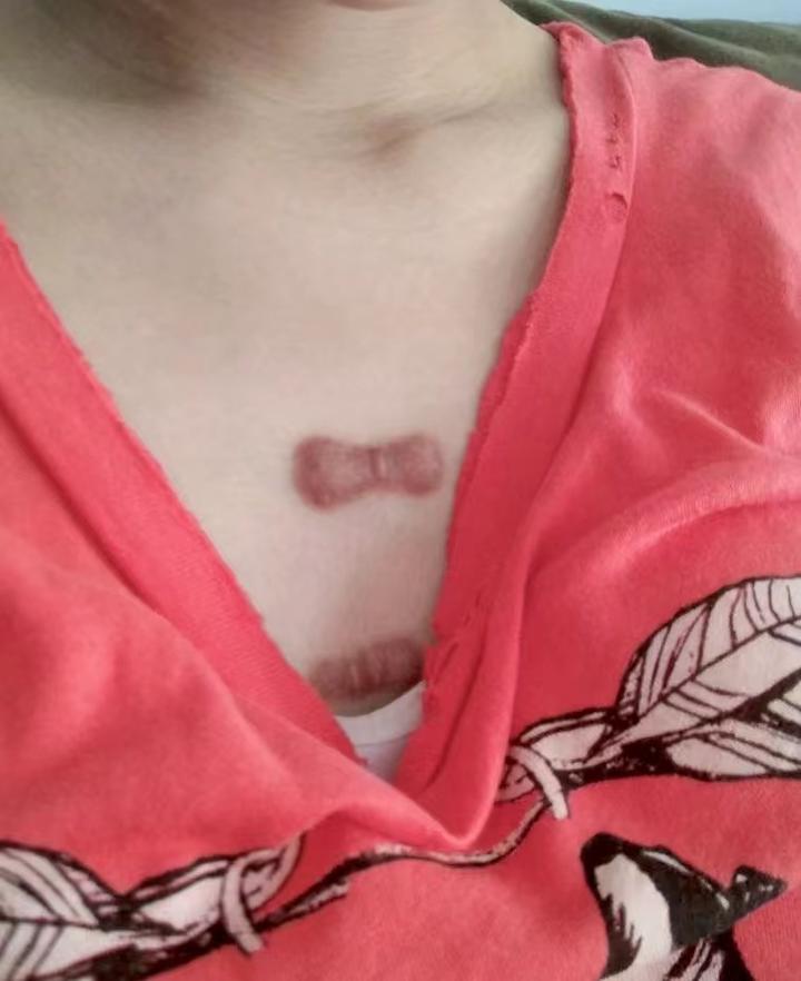 术后疤痕鼓起来又红又难看?别慌!过来人给你支几招!