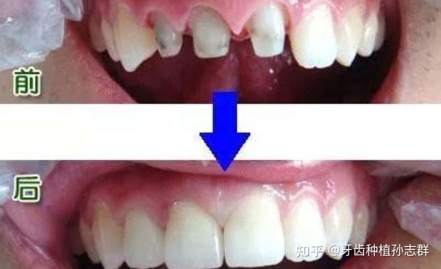 镶全瓷牙能用多久,有何优势? - 知乎