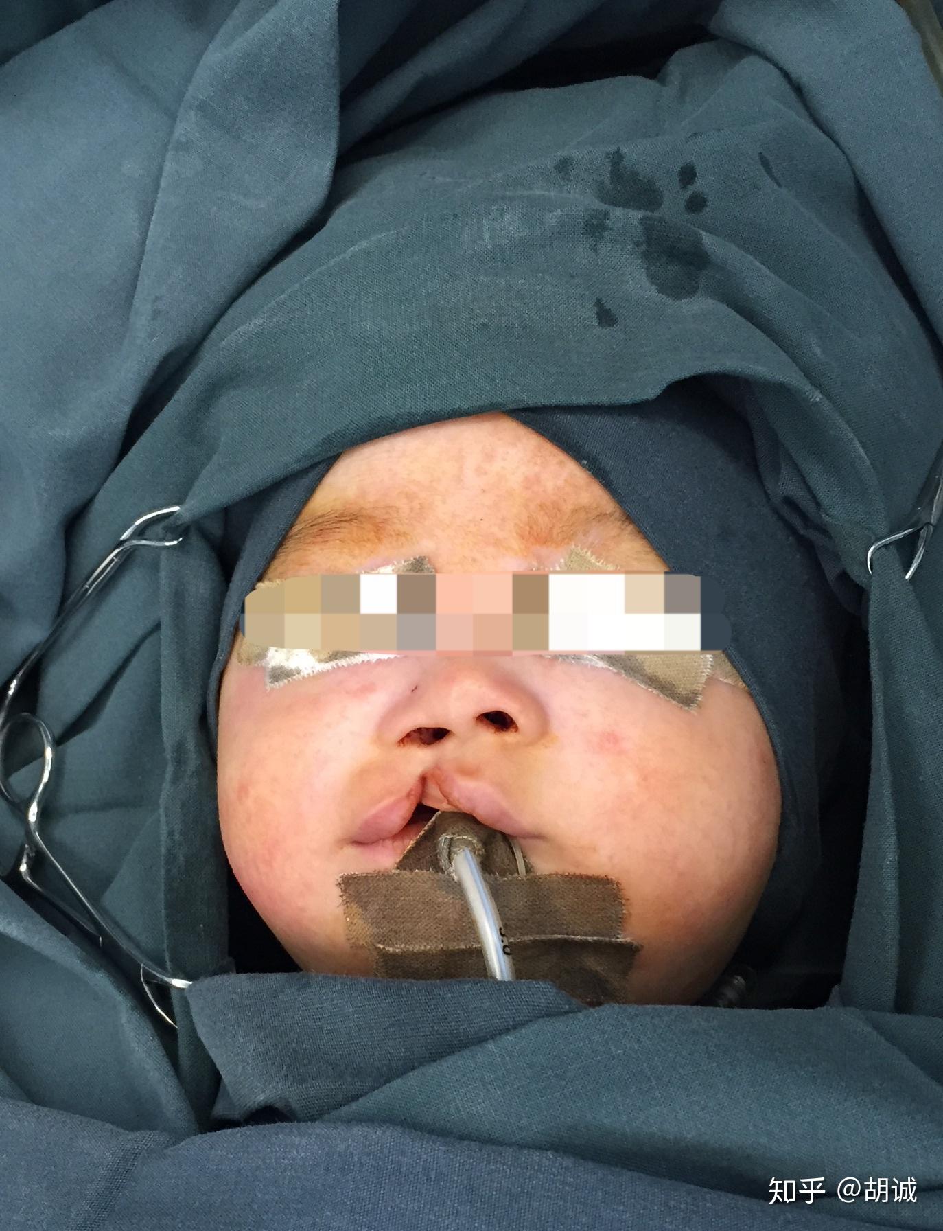 孕妈们四维要是检查出胎儿唇腭裂你们会不会要? - 知乎