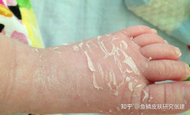 婴儿皮肤干燥像鱼鳞图片