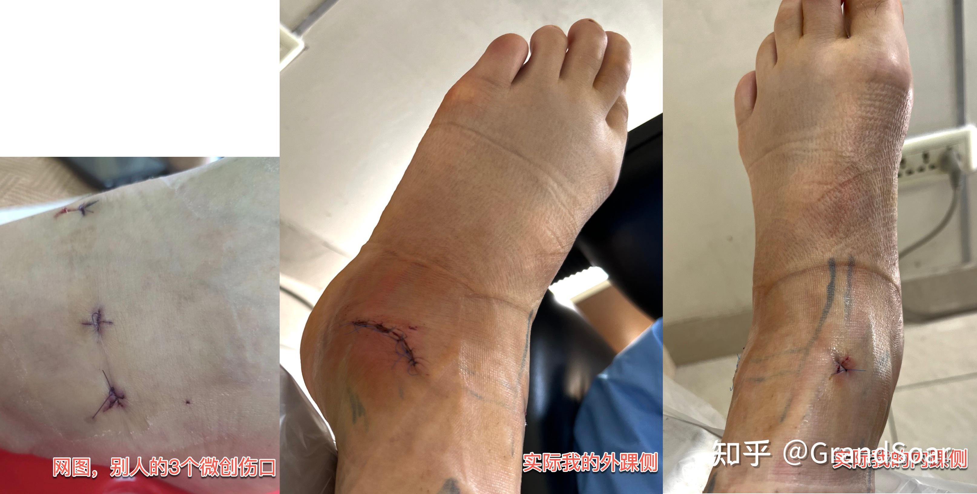 左脚踝距腓前韧带撕裂——手术和康复历程(第二部分住院及手术经历)