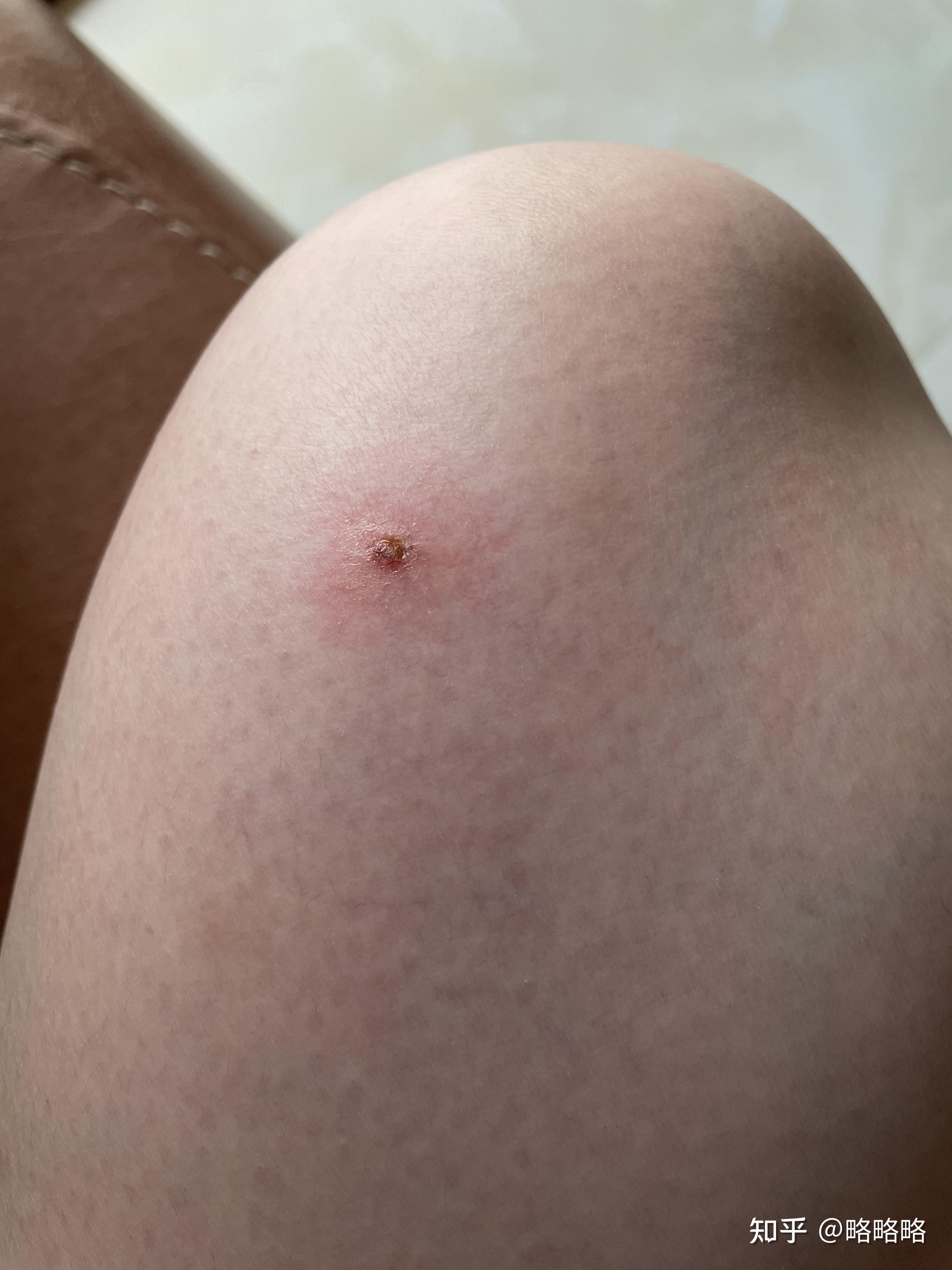 湿疹皮肤溃烂了怎么处理啊? - 知乎